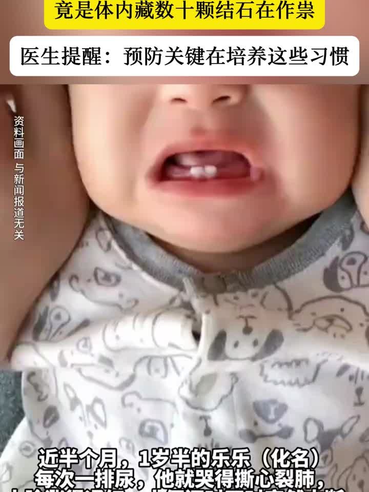 一岁半幼儿每次排尿都哭闹不止。原因竟是体内有数十颗结石!