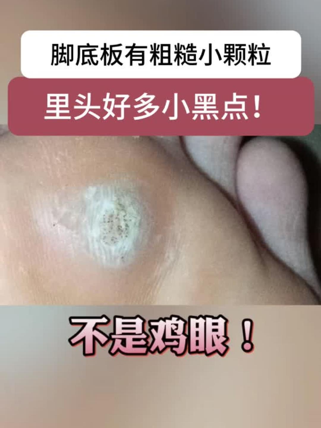 脚底长出带黑点的小疙瘩?别急着当鸡眼,小心是跖疣在作祟!