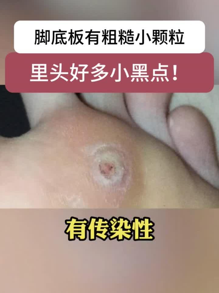 脚底板长小疙瘩,里面有很多小黑点,可别当鸡眼治!这是跖疣