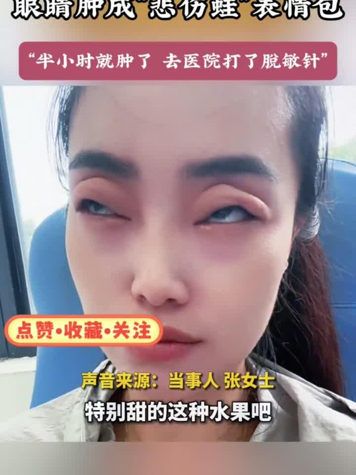 女子空腹吃两颗杨梅致过敏,眼睛肿成“悲伤蛙”表情包