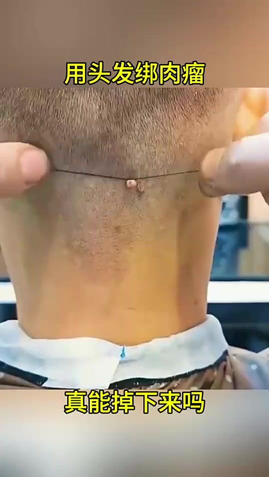 用头发绑肉瘤,真能掉下来吗