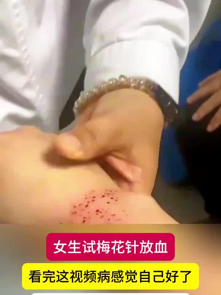 女子体验梅花针放血立竿见影,网友直呼:错怪中医了!