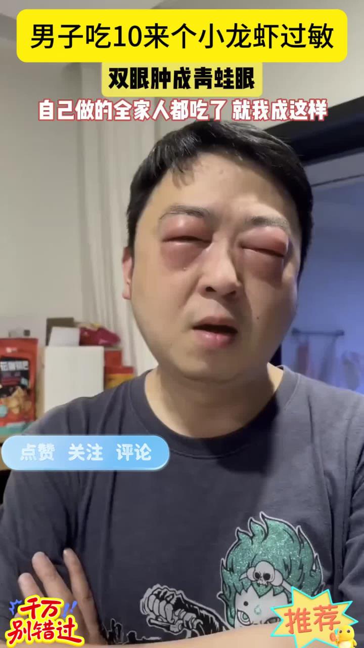 养生:近日,江苏一男子吃过小龙虾后,双眼红肿过敏肿成青蛙眼一样