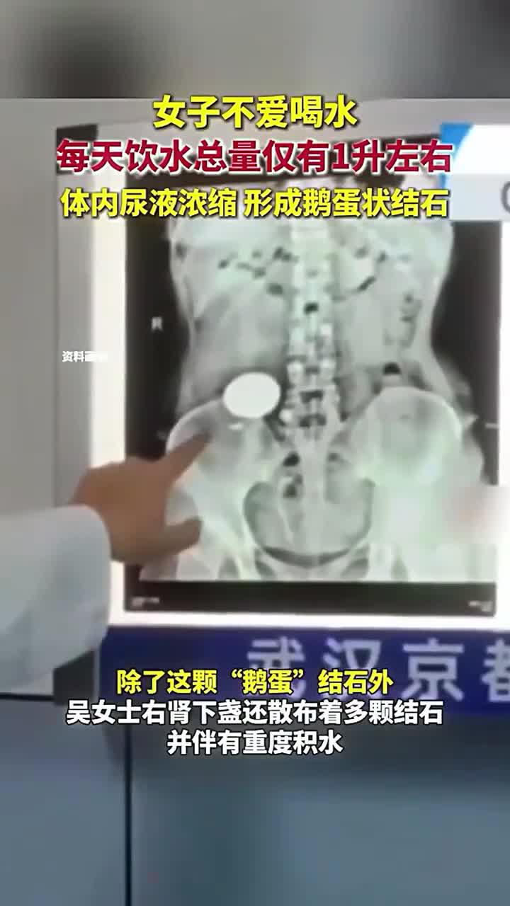 女子不爱喝水,每天饮水总量仅有1升左右,体内尿液浓缩,形成鹅