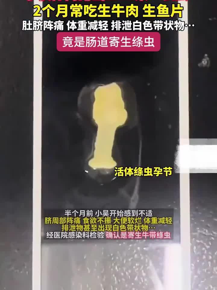 2米7长虫体内排出!小伙因常食生牛肉、生鱼片感染绦虫