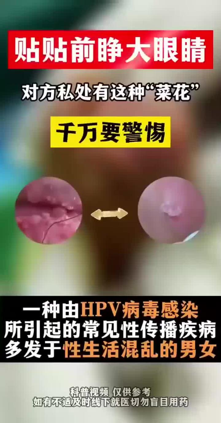 私处菜花状异物需警惕