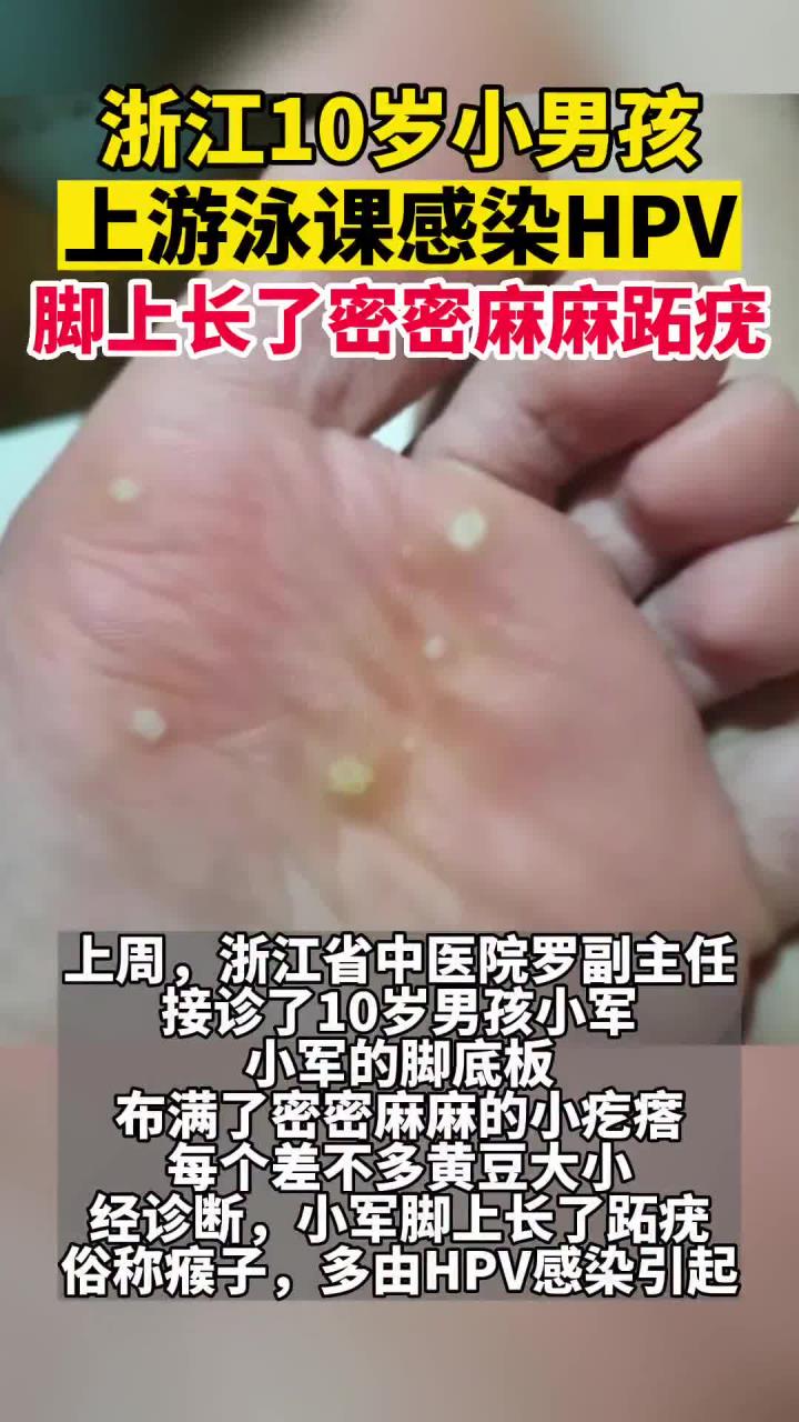 10岁男孩上游泳班感染HPV!脚上长了密密麻麻跖疣!