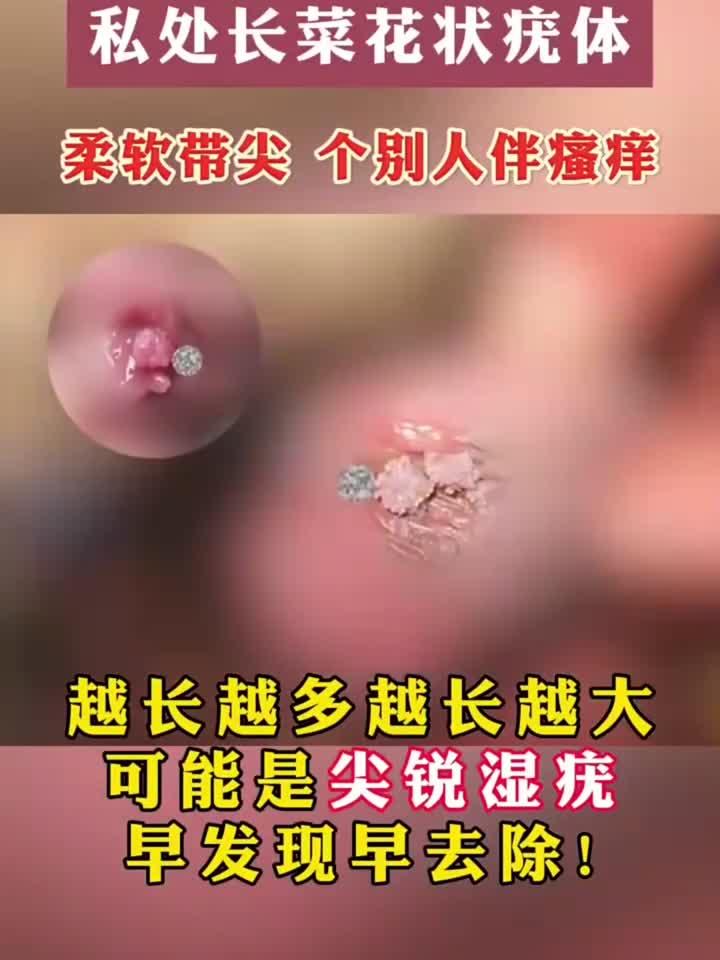 健康常识:私处长尖锐湿疣的体现