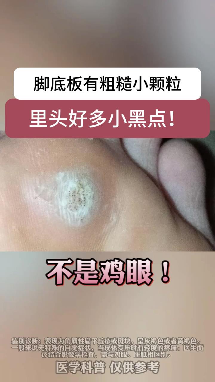 脚底板长小疙瘩,里面有很多小黑点,可别当鸡眼治!这是跖疣