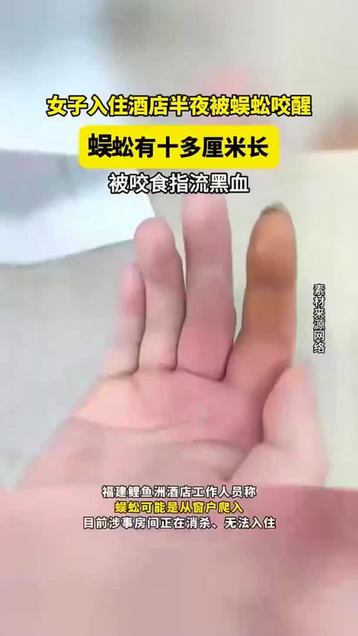 女子入住酒店半夜被蜈蚣咬醒