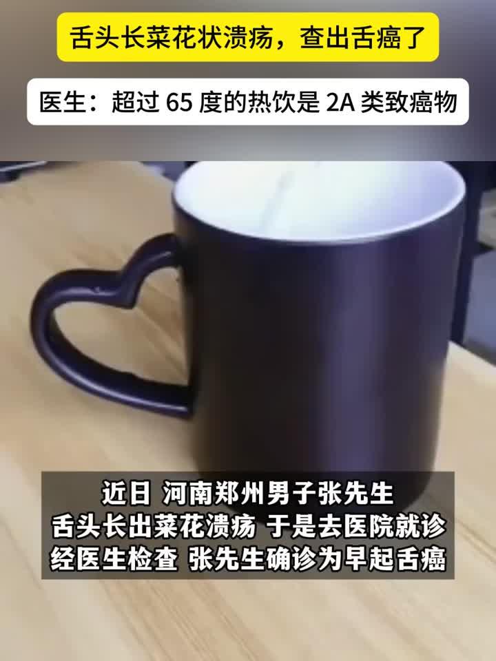 46岁养生迷20年滚烫热水致舌癌,舌头惊现菜花状溃疡!