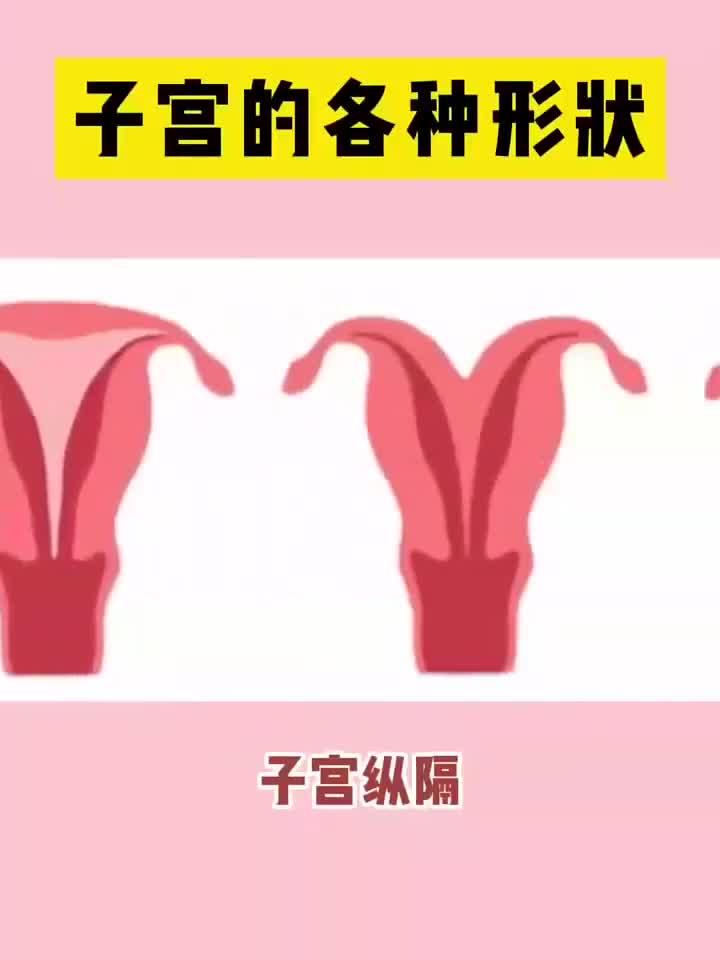 子宫的各种形状