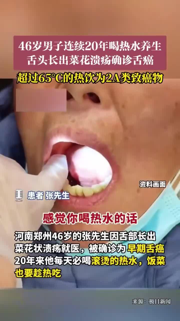 热水养生20年致舌癌,46岁男子确诊菜花样溃疡