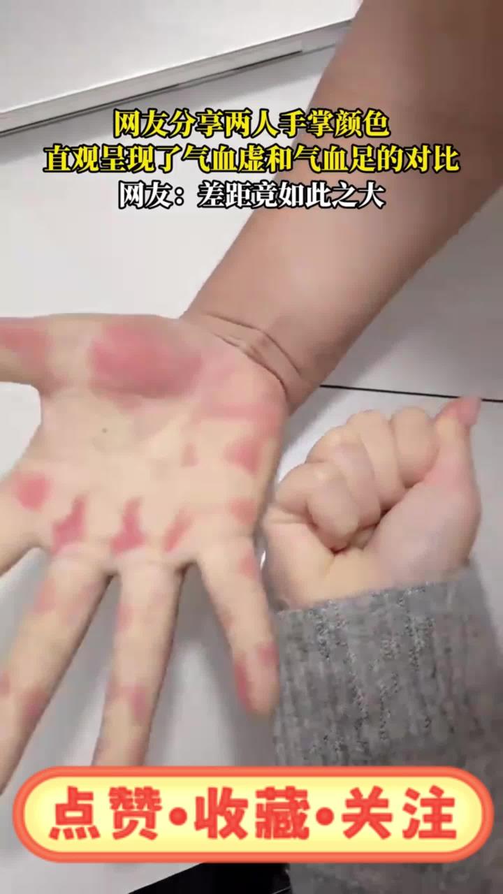 网友分享两人手掌颜色,直观呈现了气血虚和气血足的对比
