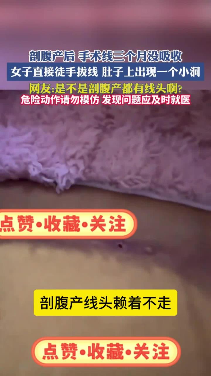 剖腹产后手术线三个月没吸收,女子直接徒手拔线