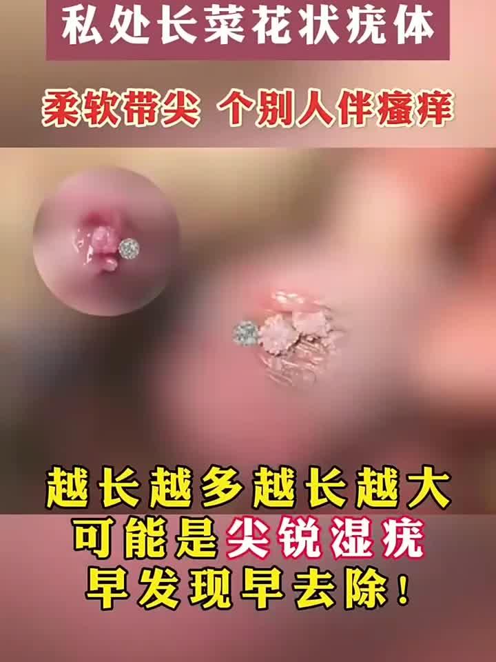 私处长尖锐湿疣的体现