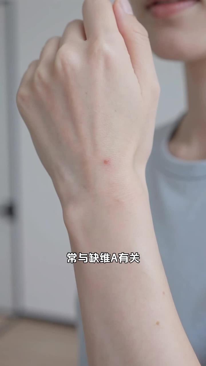 鸡皮肤,手臂大腿一粒粒,是缺乏维生素A吗?吃什么能缓解?