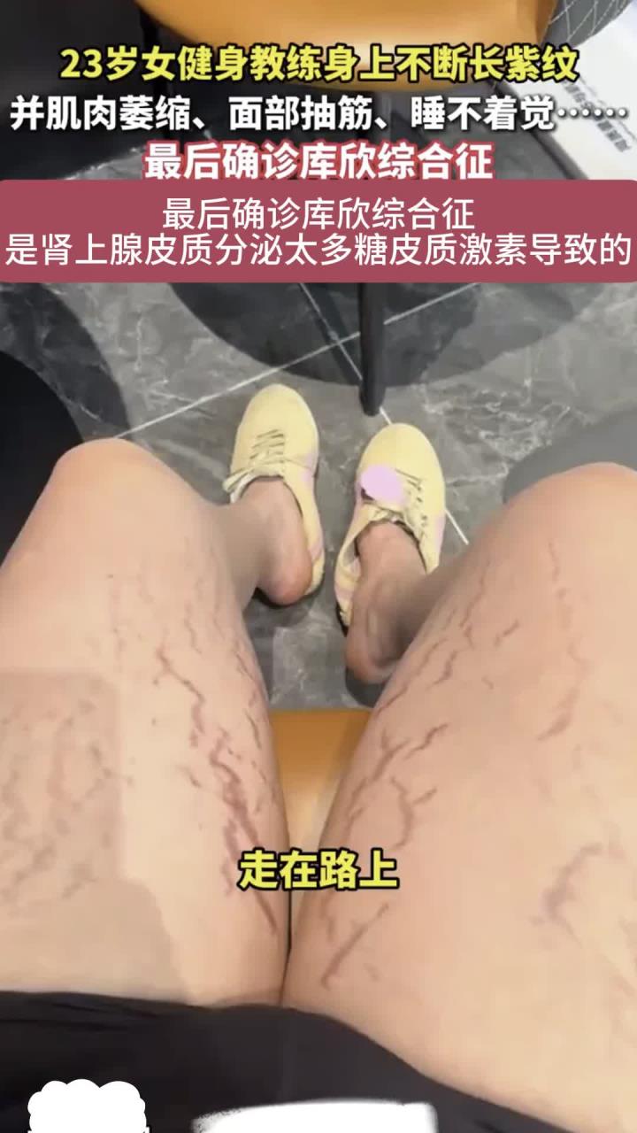 健养故事：23岁女健身教练身上长紫纹并肌肉萎缩 最终确诊为库欣综合征
