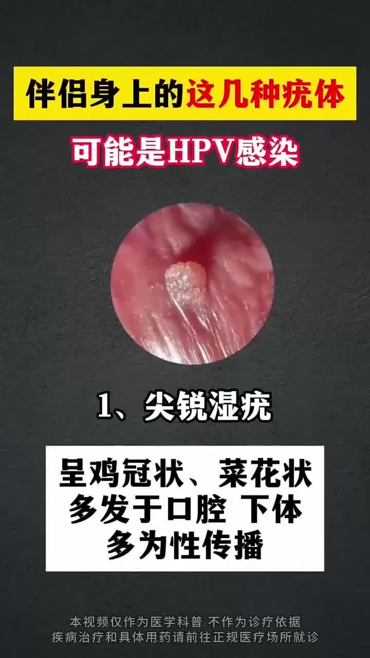 伴侣疣体警示HPV风险
