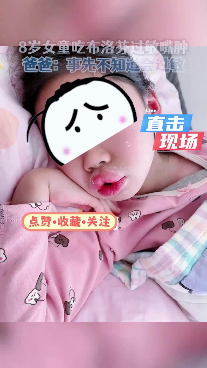 女孩吃布洛芬过敏嘴肿成可达鸭,爸爸:不知道会过敏