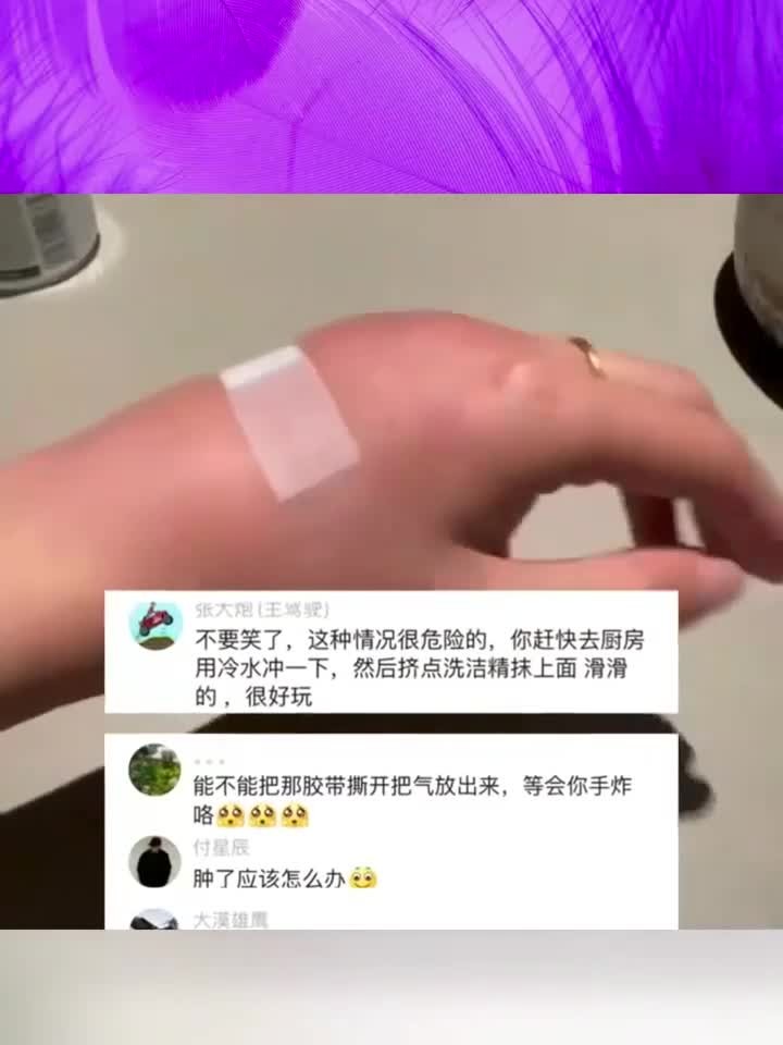 日常健康知识小分享:女子输液后手肿成“发面馒头”