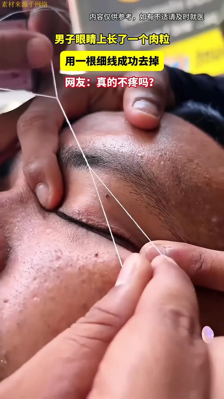 男子眼睛上长了一个肉粒,用一根细线成功去掉,网友:真的不疼吗
