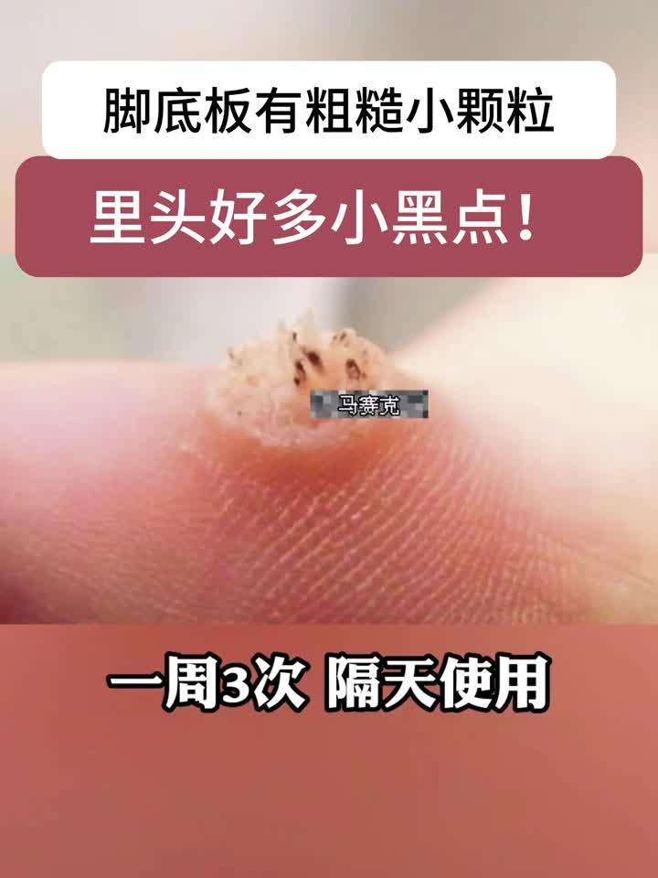 脚底长疙瘩带黑点?别误当鸡眼,小心是跖疣!