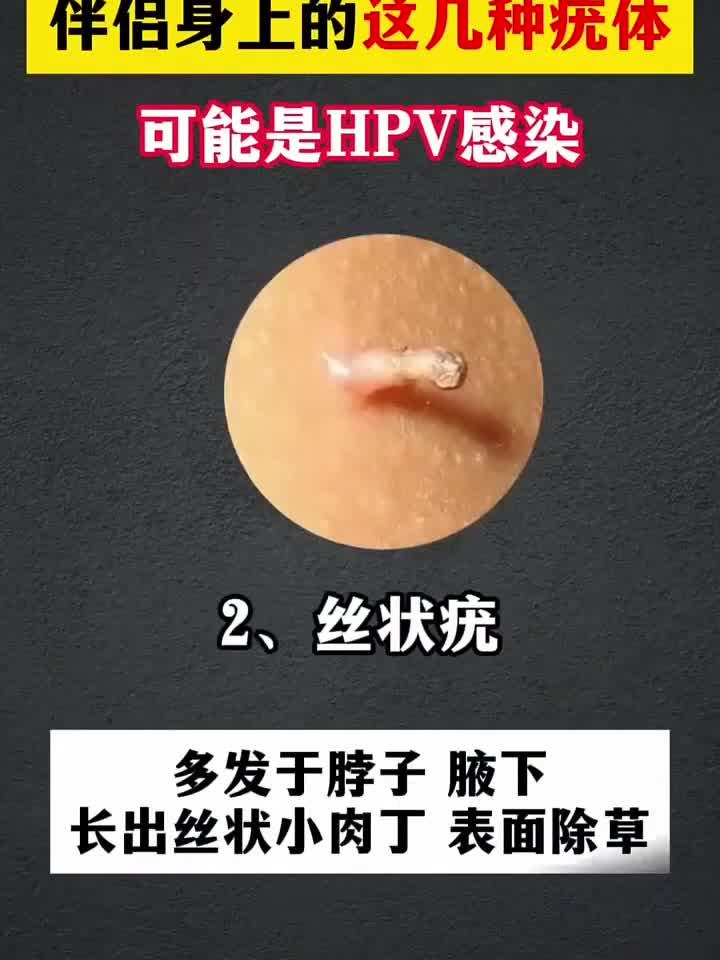 伴侣身上的这几种疣体 可能是hpv感染
