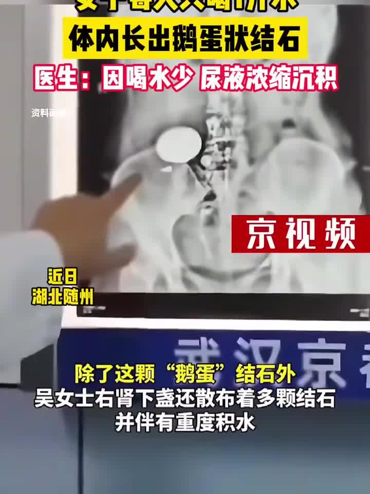 女子日饮一升水,竟在体内养出“鹅蛋”大结石!