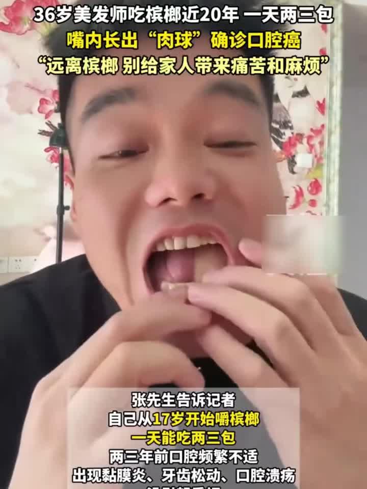 36岁美发师吃槟榔近20年,一天两三包,嘴内长出“肉球”