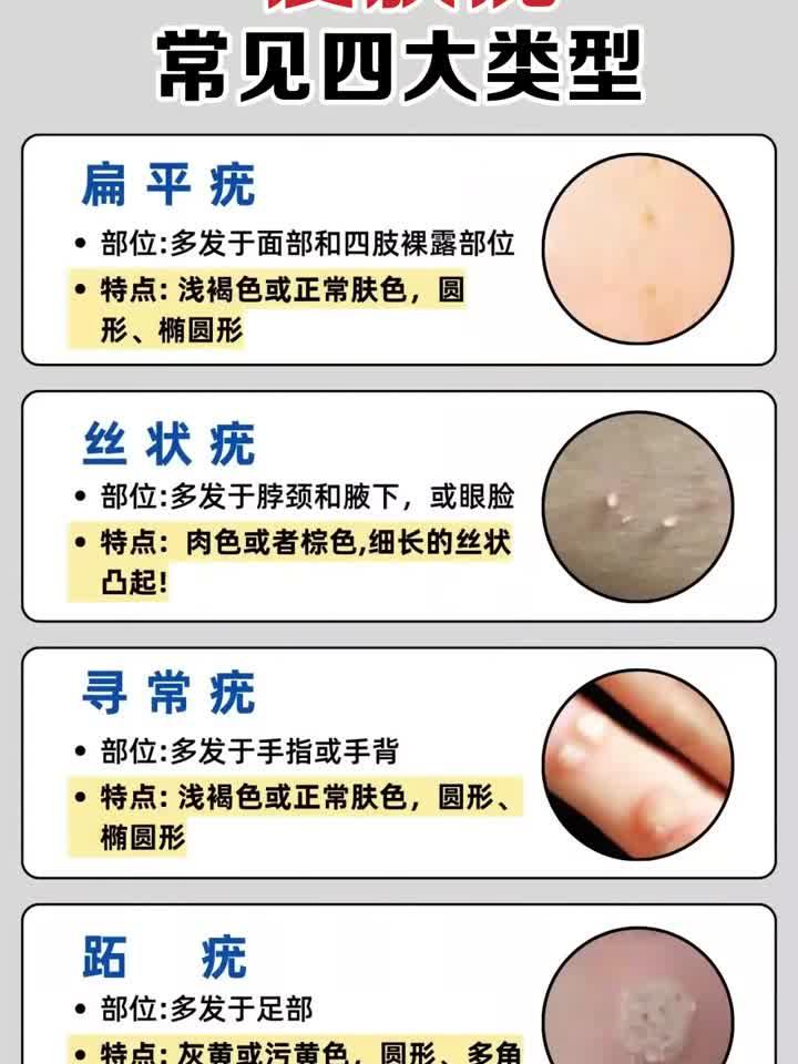 皮肤疣分4大类型:症状+图片对照,你属于哪一种?