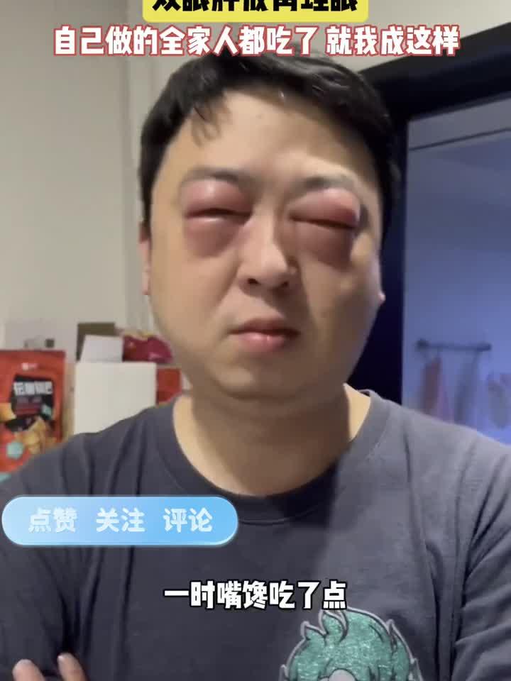 近日,江苏一男子吃过小龙虾后,双眼红肿过敏肿成青蛙眼一样