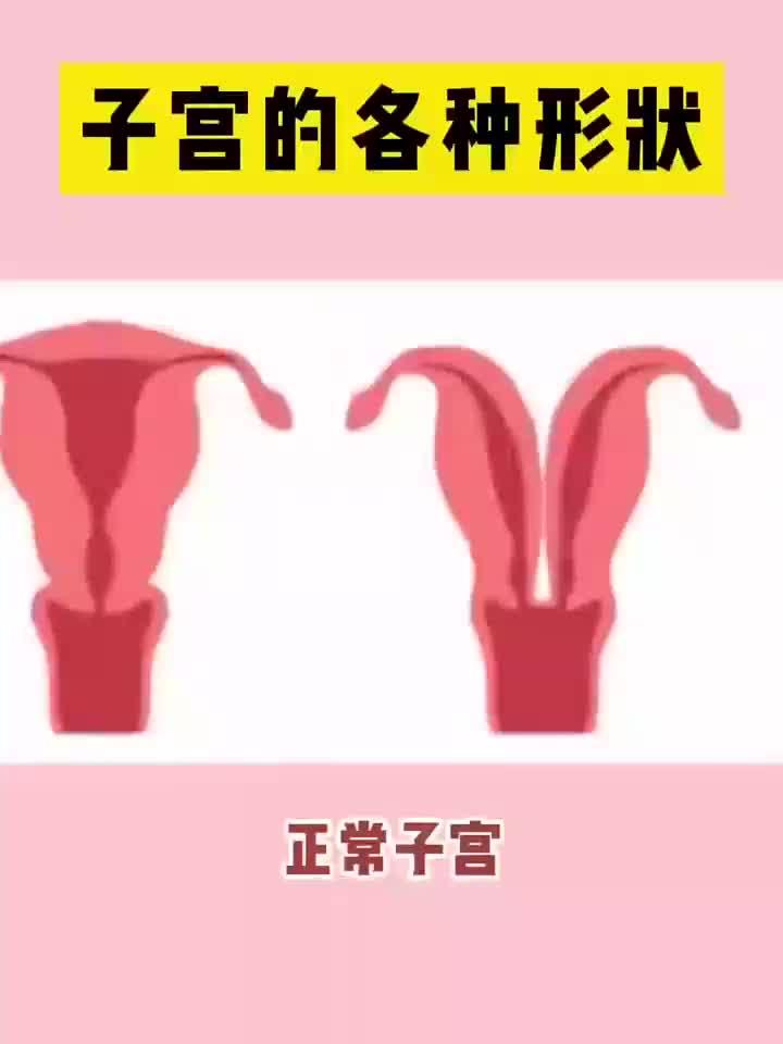 子宫的各种形状