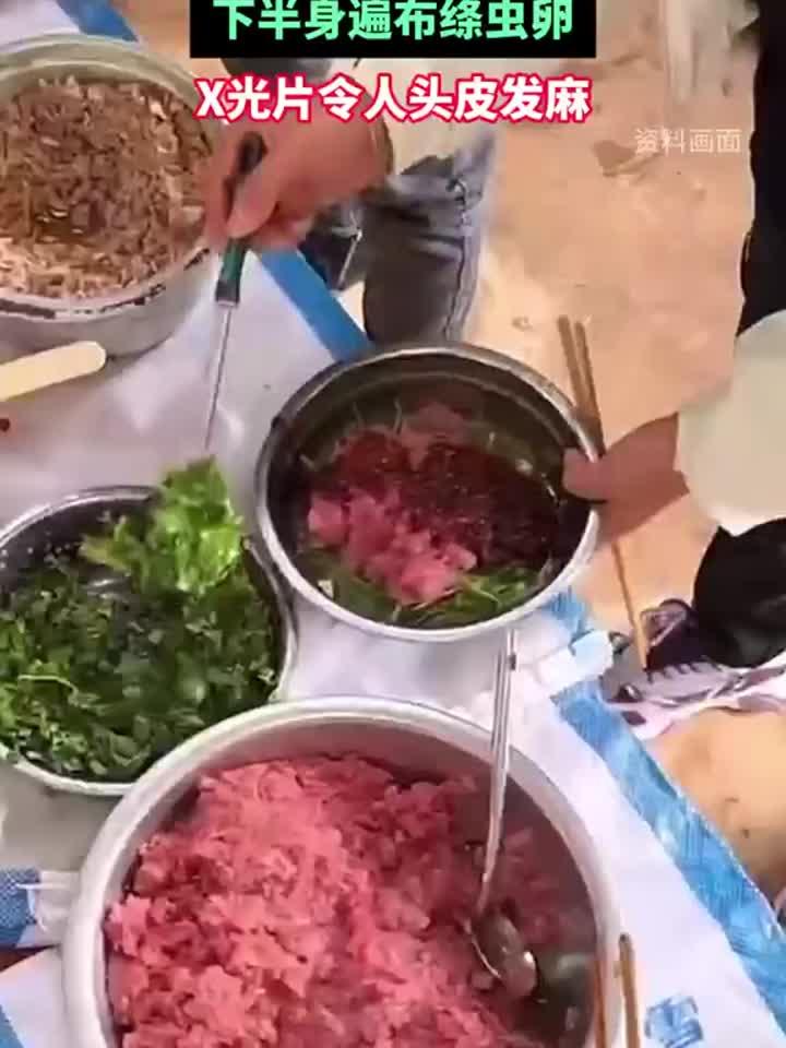 男子误食未熟猪肉险丧命，寄生虫感染敲响警钟