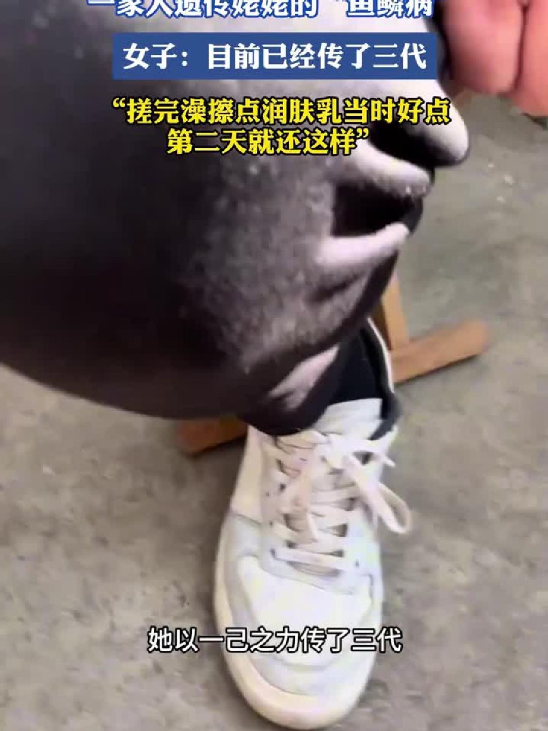 鱼鳞病三代相传，女子无奈：搓澡润肤仅能缓解一时