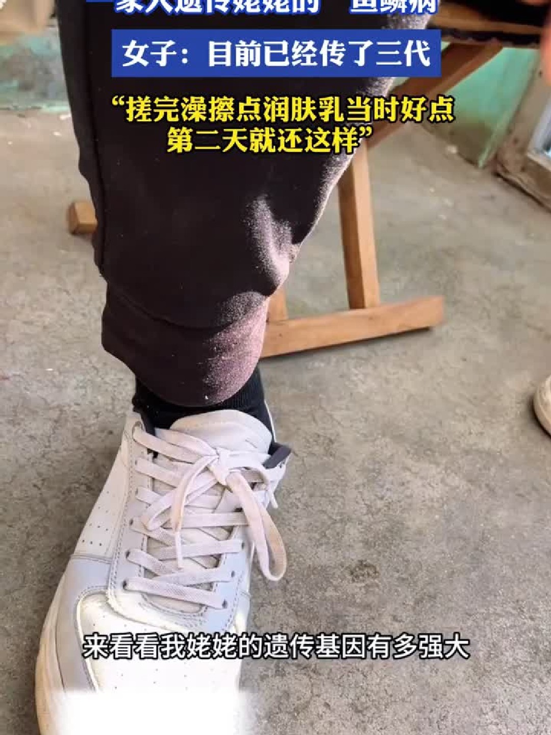 一家人遗传姥姥的“鱼鳞病”，女子：目前已经传了三代，搓完澡擦点润肤乳当时好点第二天就还这样