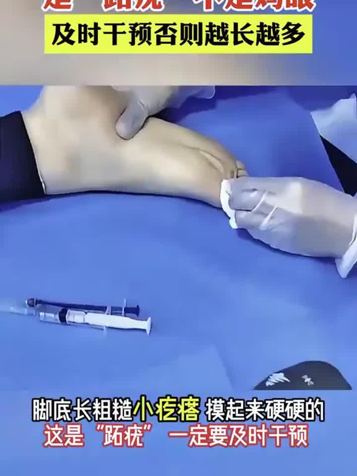 脚底长“鸡眼”?当心是跖疣!拖延不治或蔓延全身