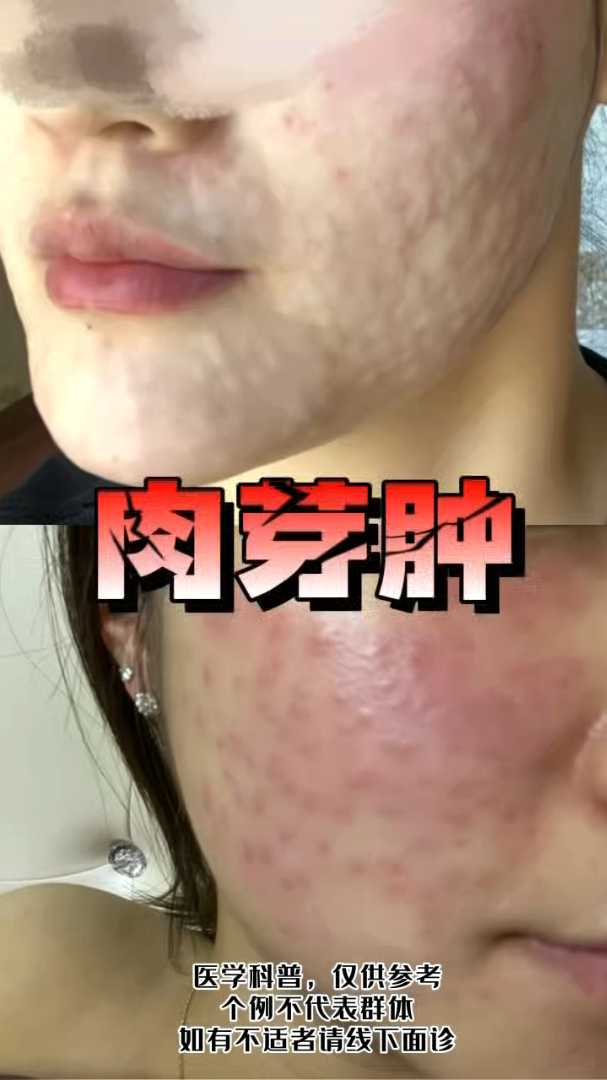 打完水光针全面部出现肉芽肿！