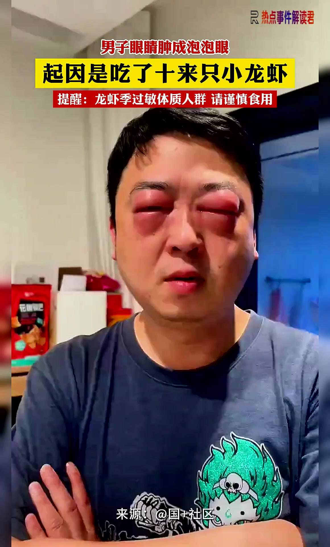 男子眼睛肿成泡泡眼 起因是吃了十来只小龙虾 提醒:龙虾季过敏