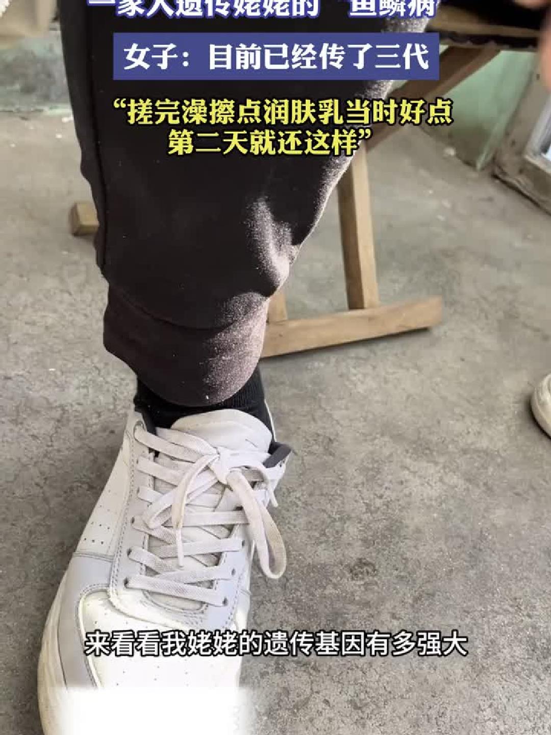 一家人遗传姥姥的“鱼鳞病”，女子：目前已经传了三代，搓完澡擦
