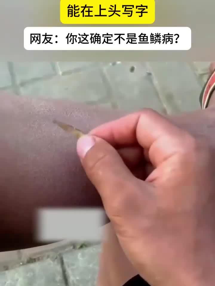 健康:男子的皮肤有点干巴,甚至能在上面写字(健康养生)