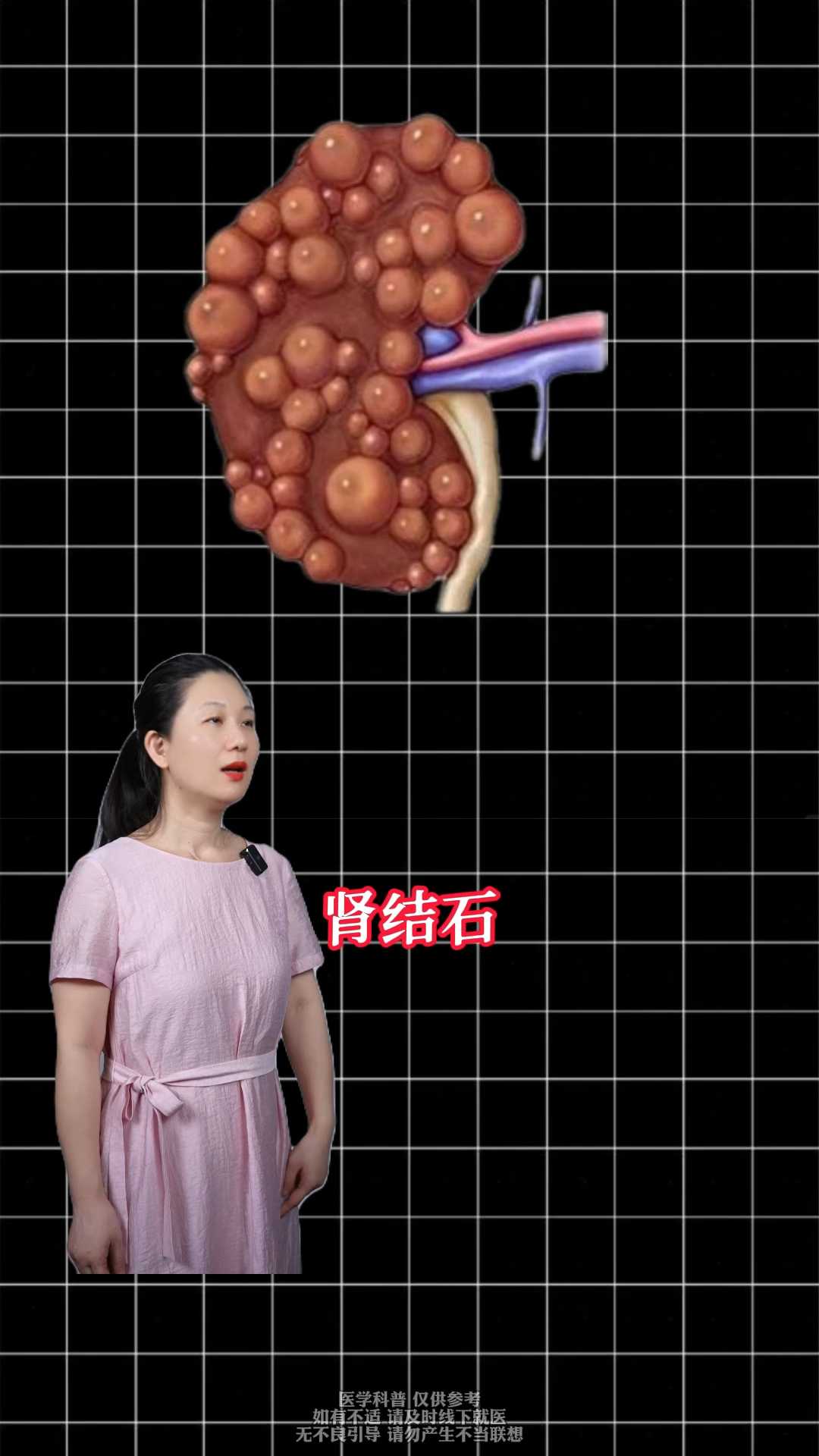 肾结石到底长啥样