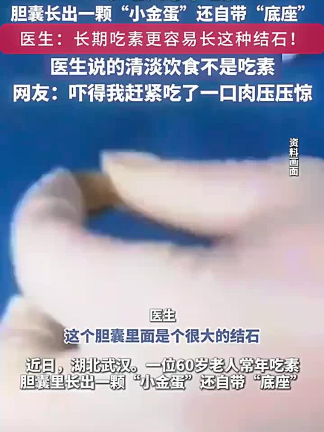 老人素食多年，胆囊竟藏金色蛋形结石