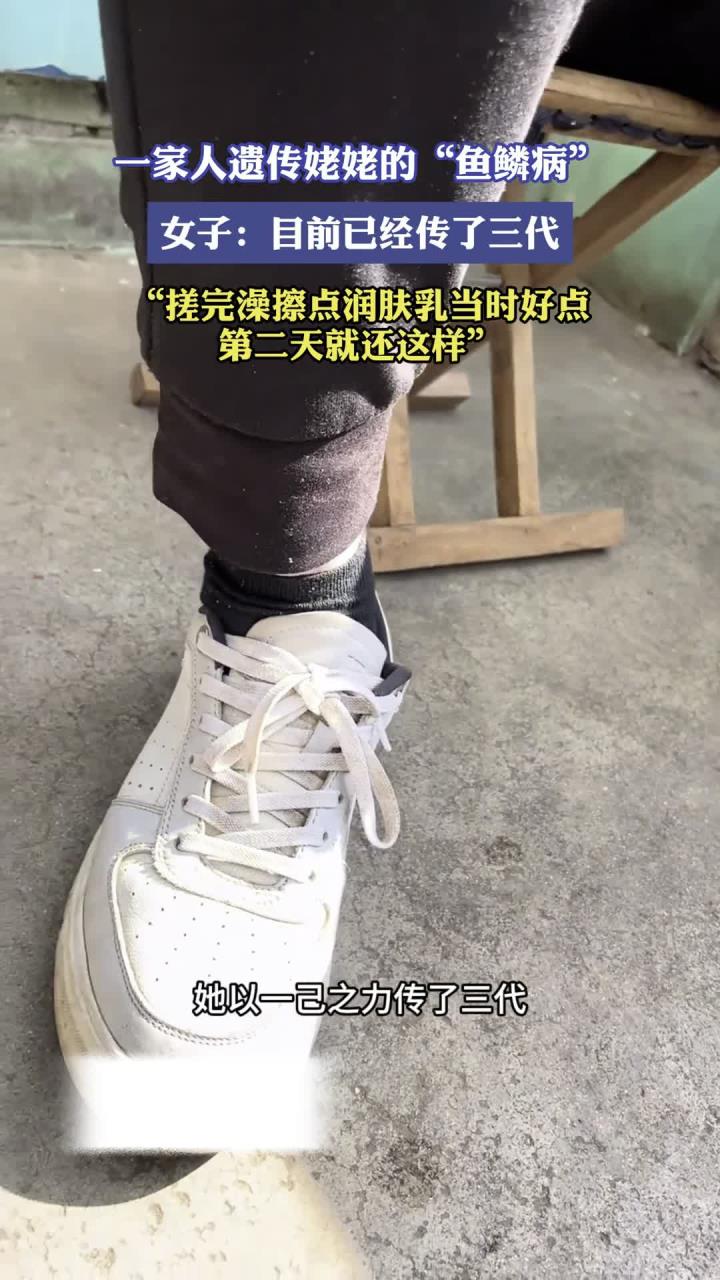 一家人遗传姥姥的“鱼鳞病”，女子：目前已经传了三代，搓完澡擦点润肤乳当时好点第二