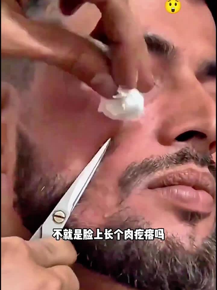 用剪刀剪肉疙瘩，看着都疼