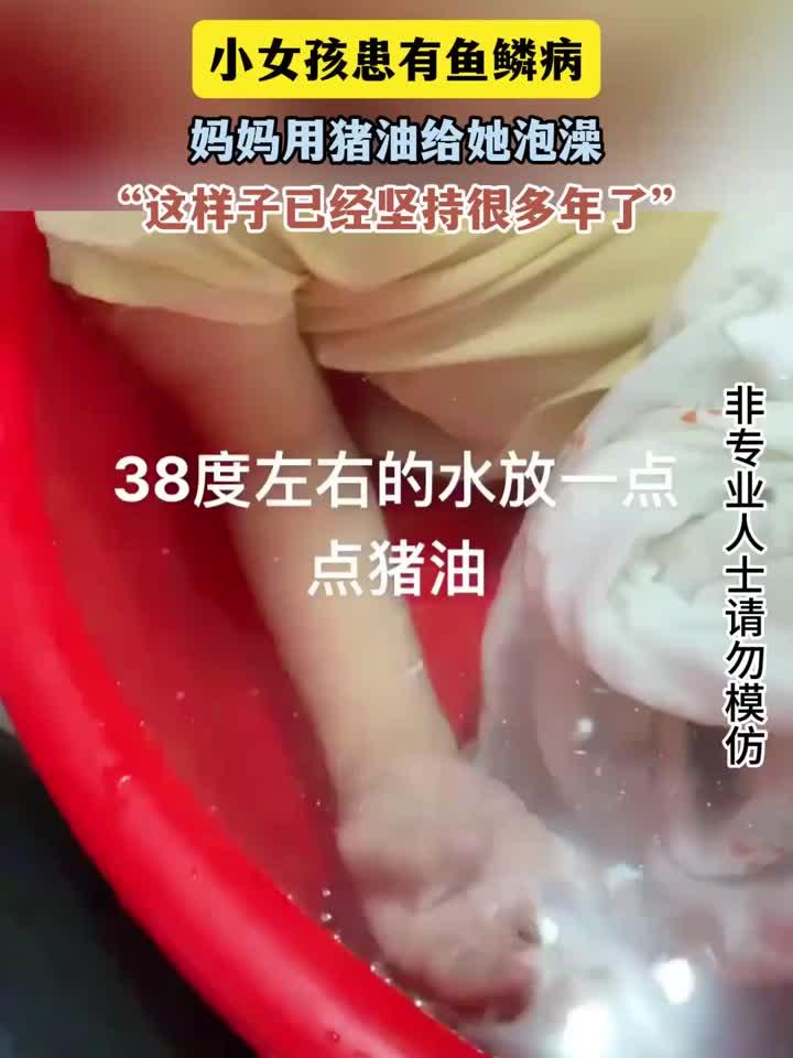 养生智慧传承:小女孩患有鱼鳞病,妈妈用猪油给她泡澡,这样子