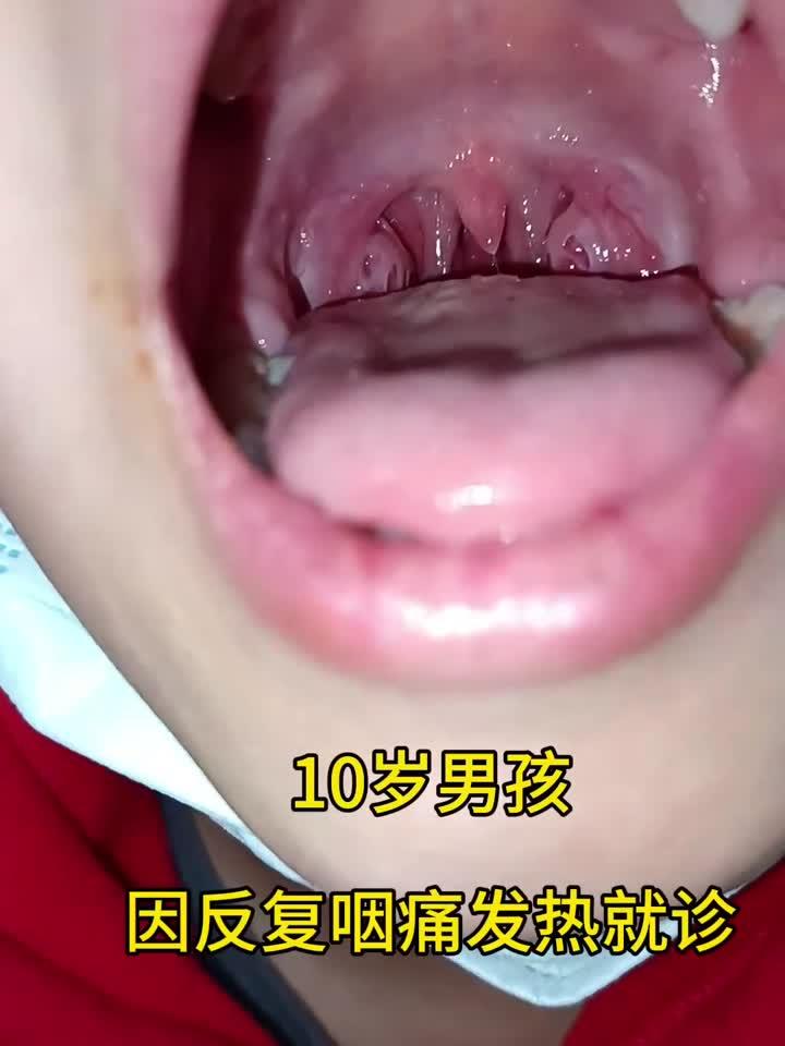 扁桃体隐窝扩大伴淋巴增生:反复咽痛不容忽视