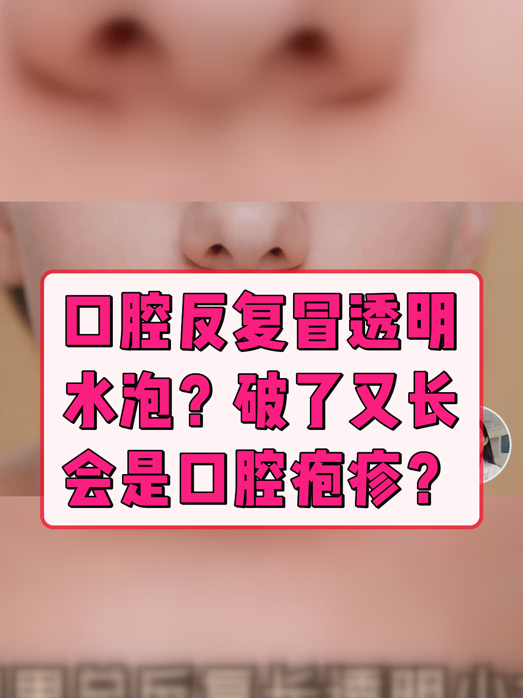 口腔反复冒透明水泡?破了又长,会是口腔疱疹?