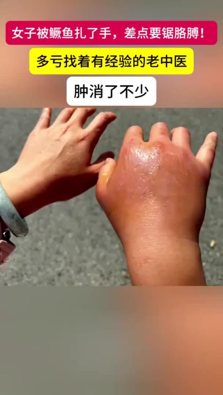 女子被鳜鱼扎伤险截肢,鱼刺虽小暗藏凶险!