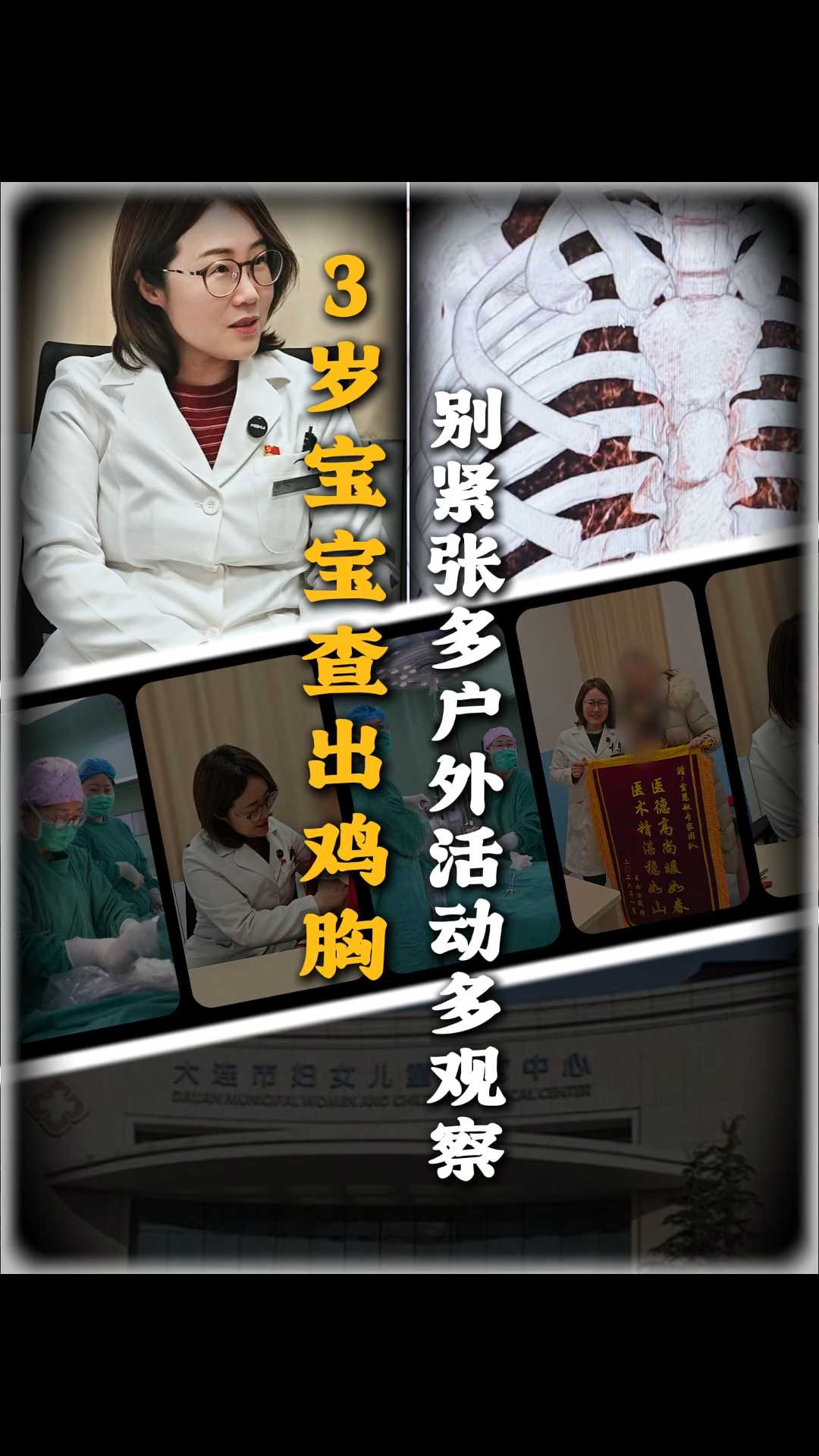 3岁宝宝查出鸡胸别紧张多户外活动多观察#贾慧敏主任##大连市妇女儿童医疗中心##小儿外科#